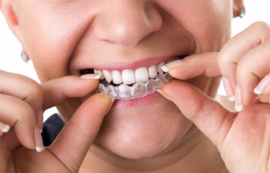 Invisalign Aligner.